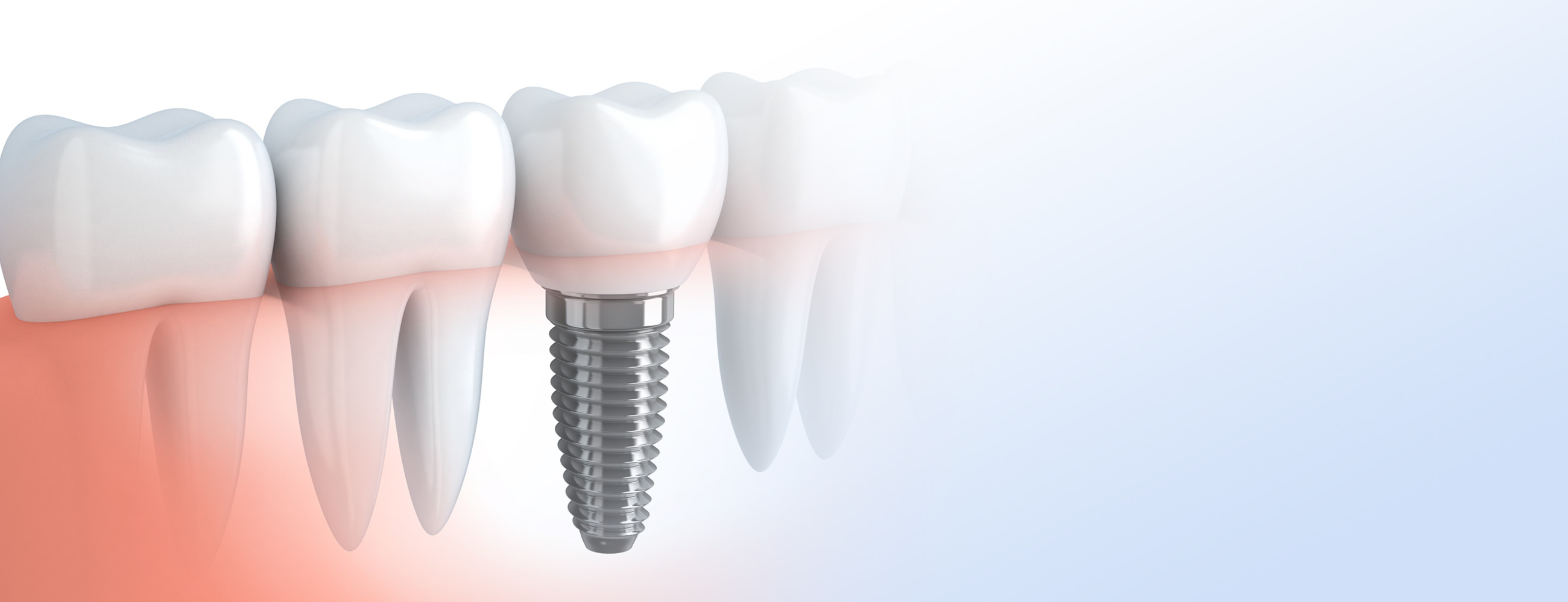 Cheap Dental Implants near you in Leicester