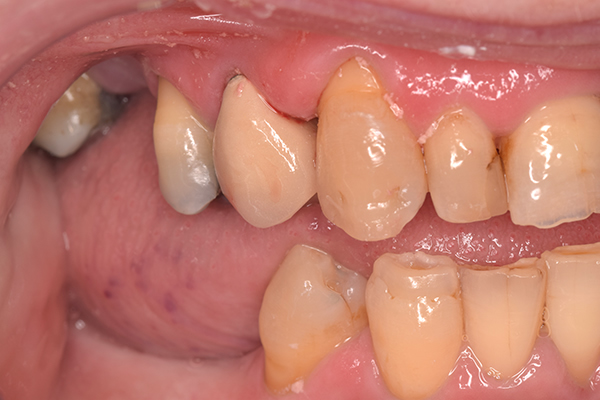 Dental crown treatment results at our Leicester denture clinic