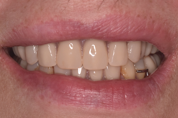 Same day dentures near you treatment results