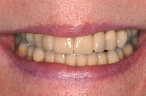 After Dental Implants in Leicester