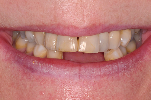 Before Dental Implants in Leicester