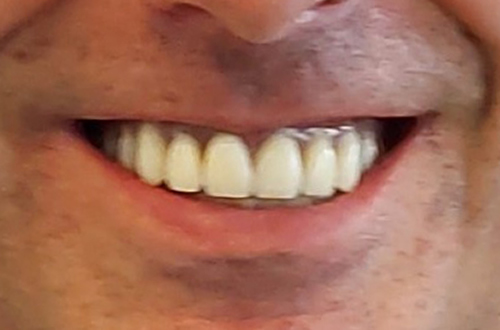 After Full Mouth Implants in Leicester