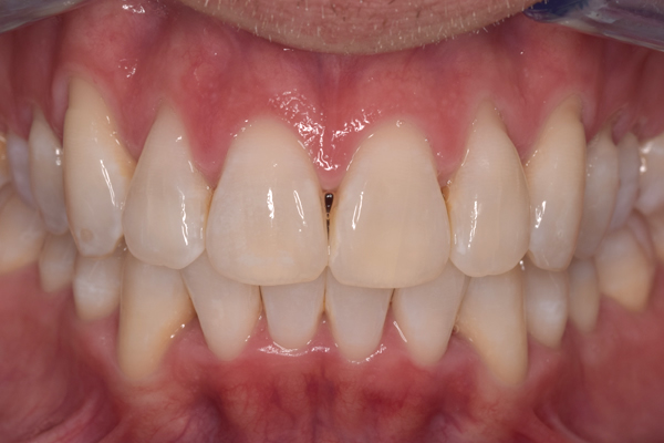 Invisalign in Leicester results