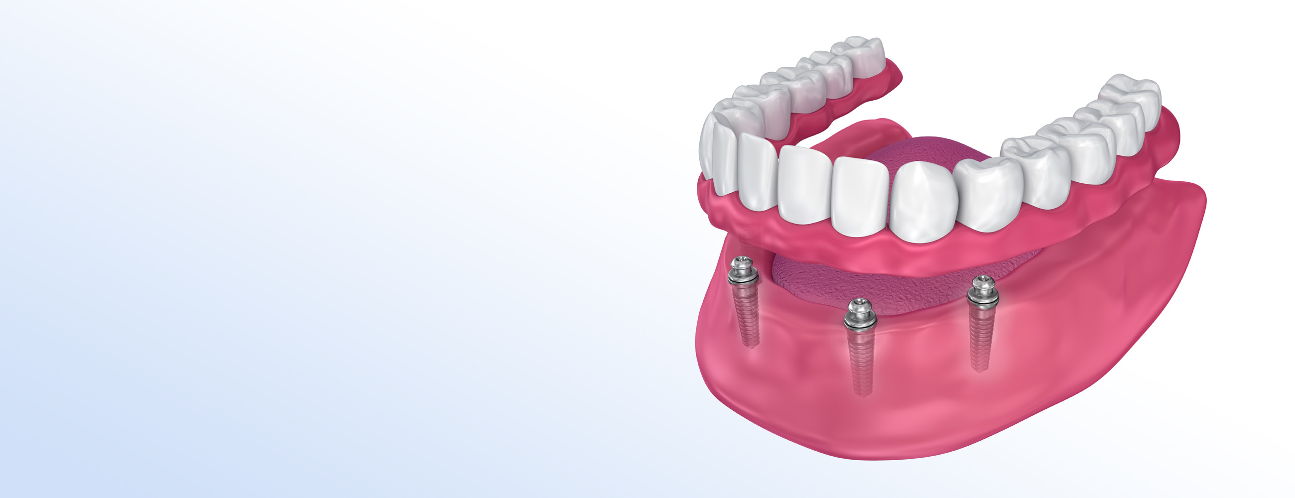 Implant Dentures at Forest House Dental in Leicester