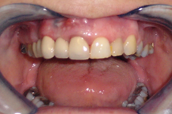 Dental Bridges After Photo