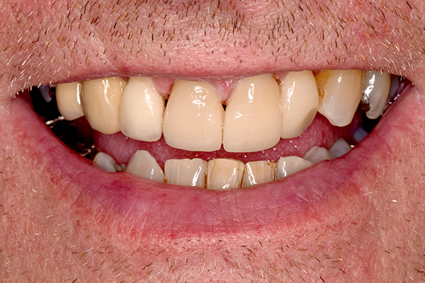 Dental Bridges After Photo