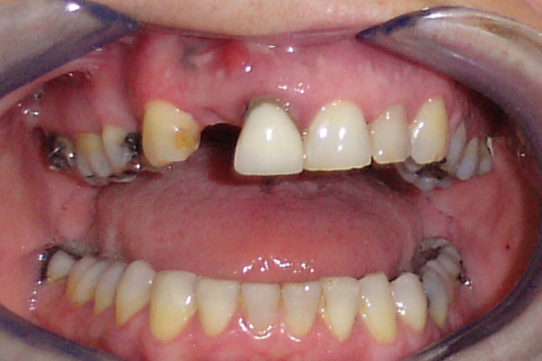 Dental Bridges Before Photo