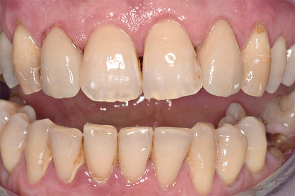 Dental Crowns After