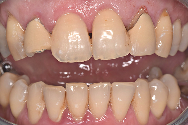 Dental Crowns Near Me