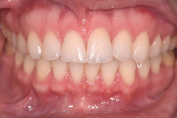 Quick Straight Teeth After