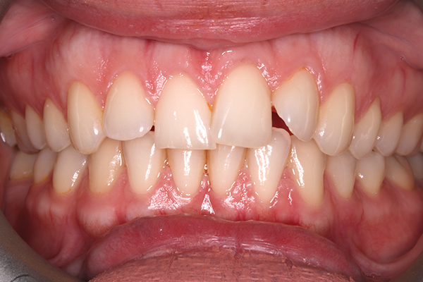 Quick Straight Teeth Before