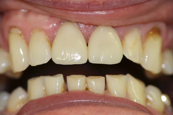 After Dental Crowns in Leicester