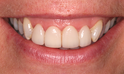 After Dental Veneers in Leicester