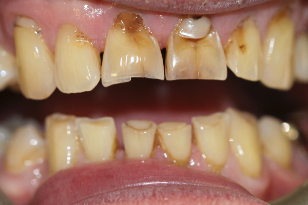 Dental Crowns Near Me