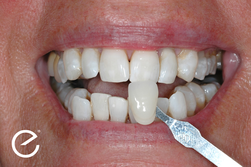 After Enlighten Tooth Whitening Treatment in Leicester