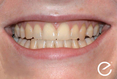 Before Enlighten Tooth Whitening Treatment in Leicester