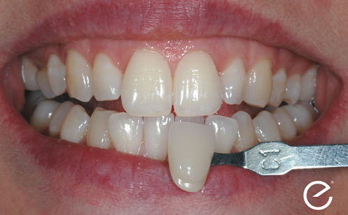 Before Enlighten Tooth Whitening Treatment in Leicester