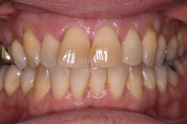 Before Tooth Whitening Treatment in Leicester