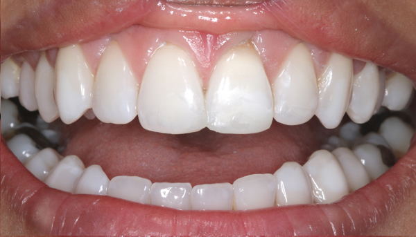 Tooth Whitening Treatment results in Leicester